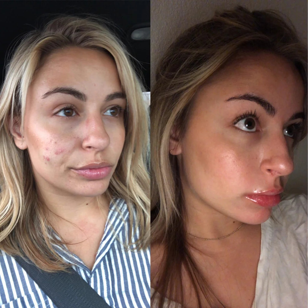 Clear Pimple Patches (36 pcs)