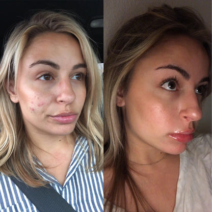 Clear Pimple Patches (36 pcs)